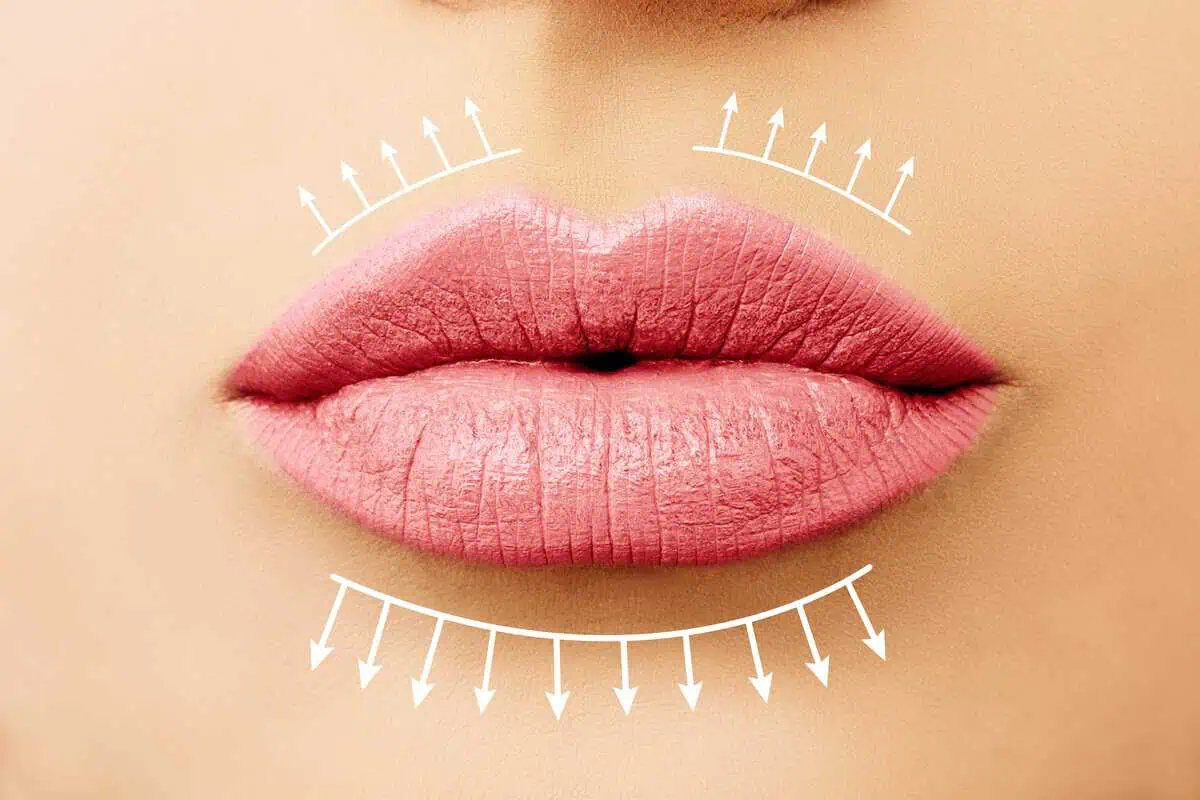 Lip Filler by LineOut Aesthetics in Carmel, IN
