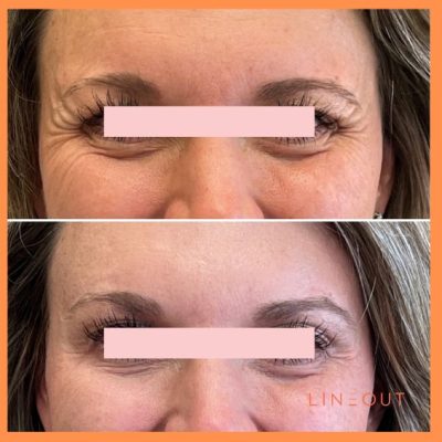 Wrinkle Relaxers Before & After 2