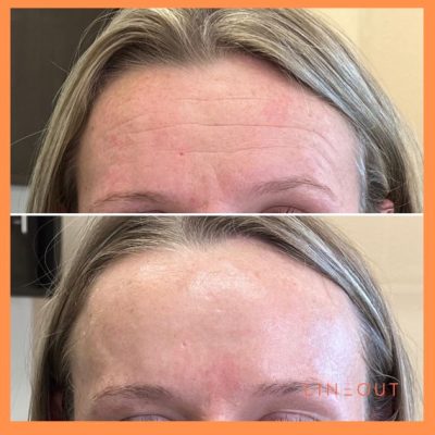 Wrinkle Relaxers Before & After 3