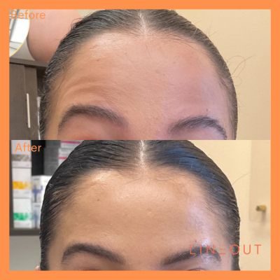 Wrinkle Relaxers Before & After 4