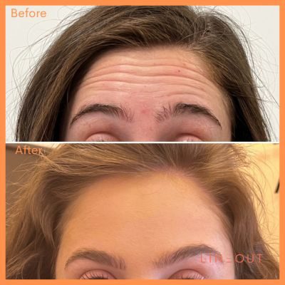 Wrinkle Relaxers Before & After 5