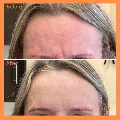 Wrinkle Relaxers Before & After 7