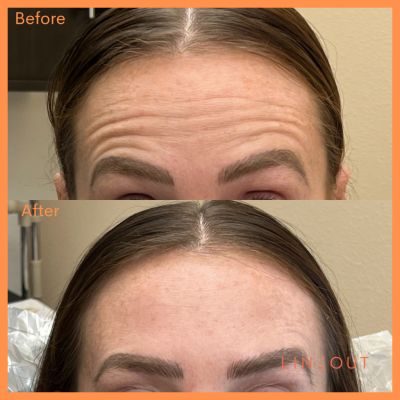 Wrinkle Relaxers Before & After 8