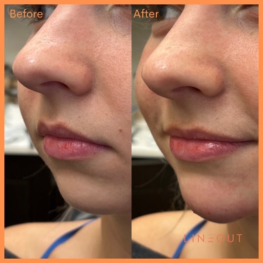 Before and After Lip Treatment | LineOut Aesthetics | Carmel, IN