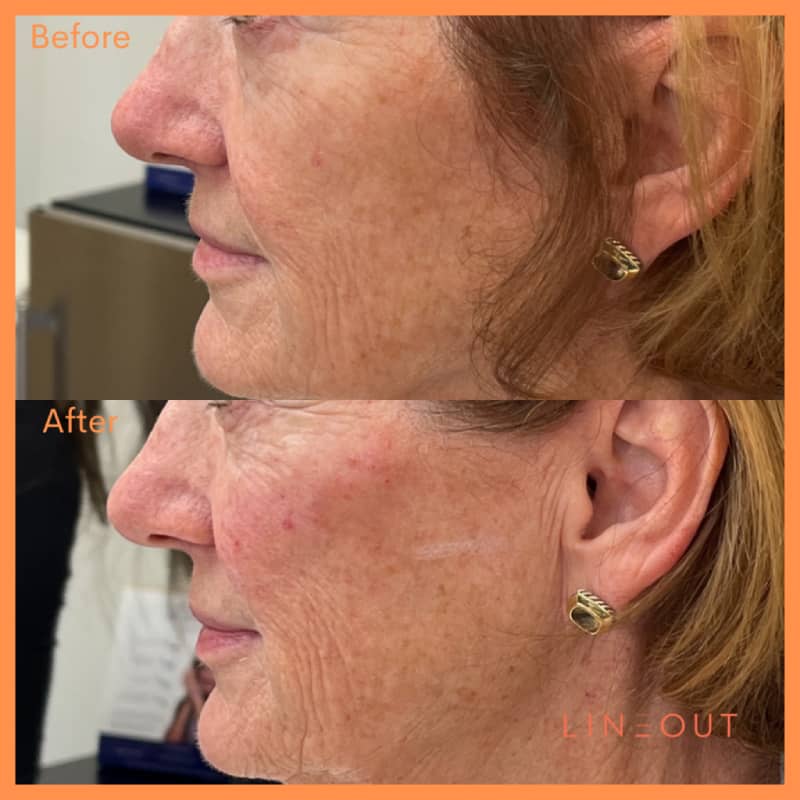 Before and After Face Acne Treatment | LineOut Aesthetics | Carmel, IN