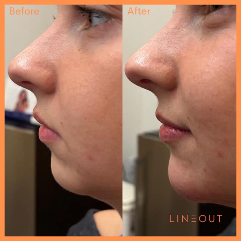 Before and After Face Acne Treatment | LineOut Aesthetics | Carmel, IN