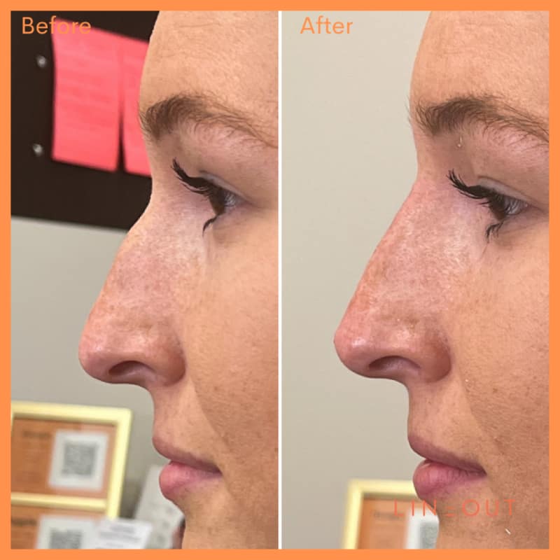 Before and After Nose Treatment | LineOut Aesthetics | Carmel, IN