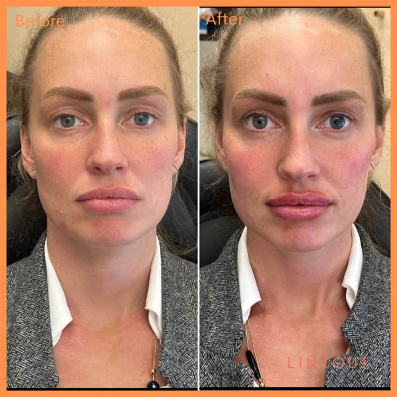 Before and After Full Face Treatment | LineOut Aesthetics | Carmel, IN