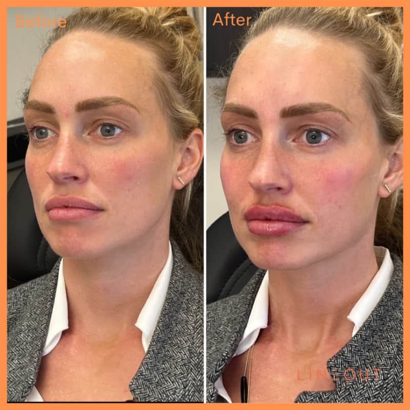 Before and After Full Face Treatment | LineOut Aesthetics | Carmel, IN