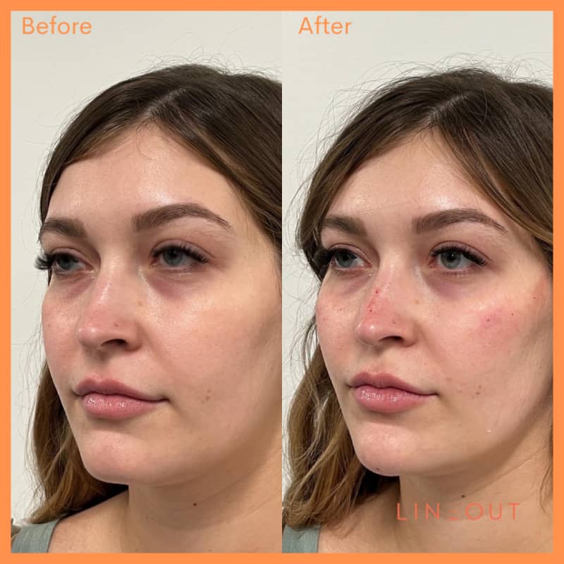 Before and After Spa Treatment | LineOut Aesthetics | Carmel, IN