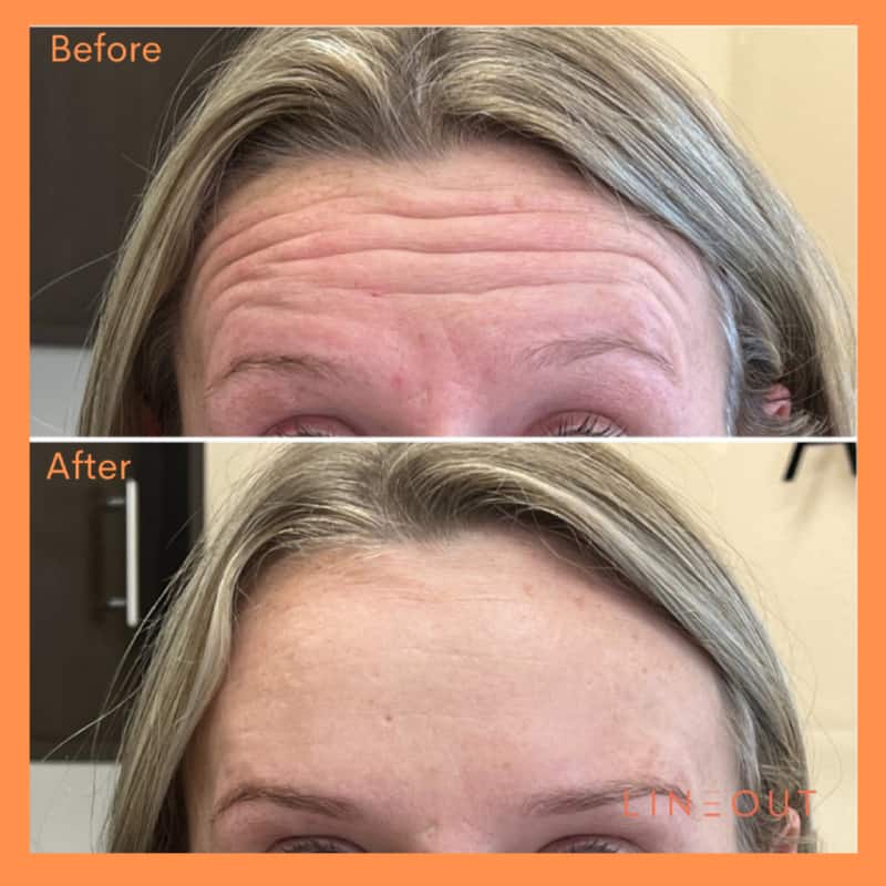 Before and After Forehead Wrinkles Treatment | LineOut Aesthetics | Carmel, IN