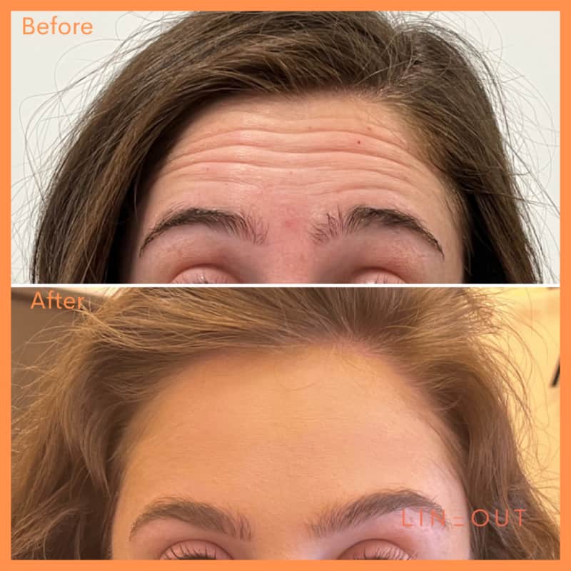 Before and After Forehead Wrinkles Treatment | LineOut Aesthetics | Carmel, IN
