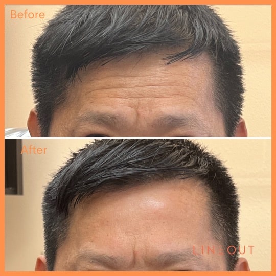 Before and After Forehead Treatment | LineOut Aesthetics | Carmel, IN