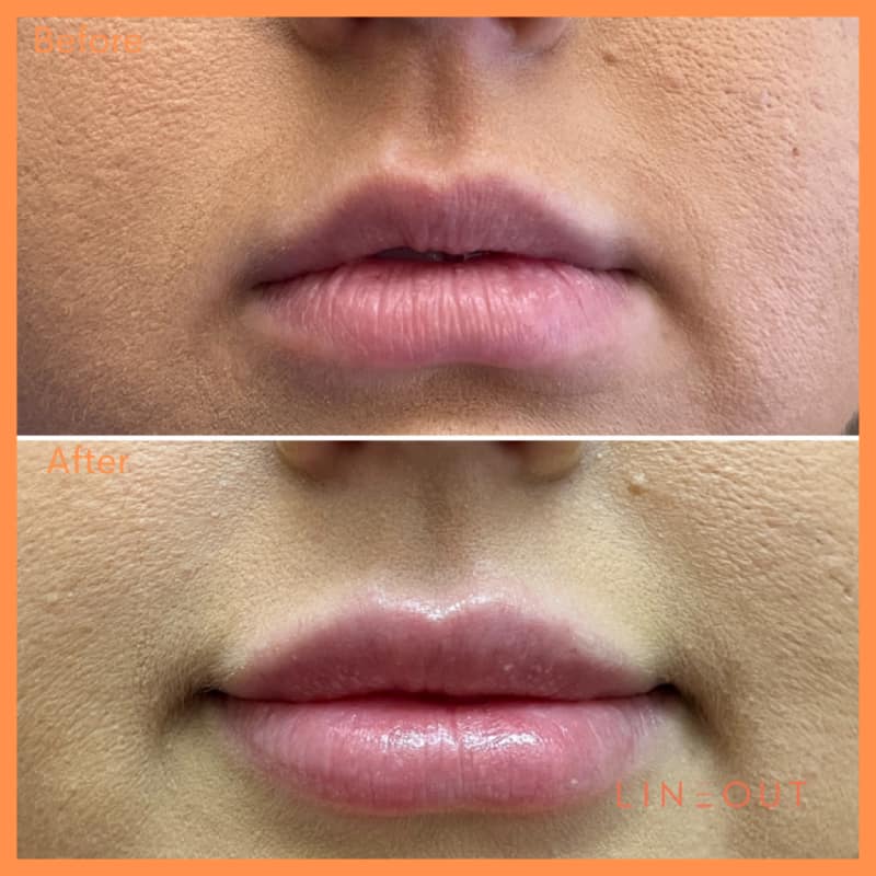 Before and After Lips Treatment | LineOut Aesthetics | Carmel, IN