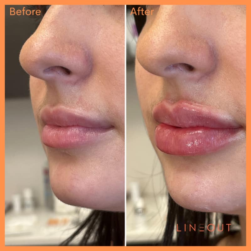 Before and After Lips Treatment | LineOut Aesthetics | Carmel, IN