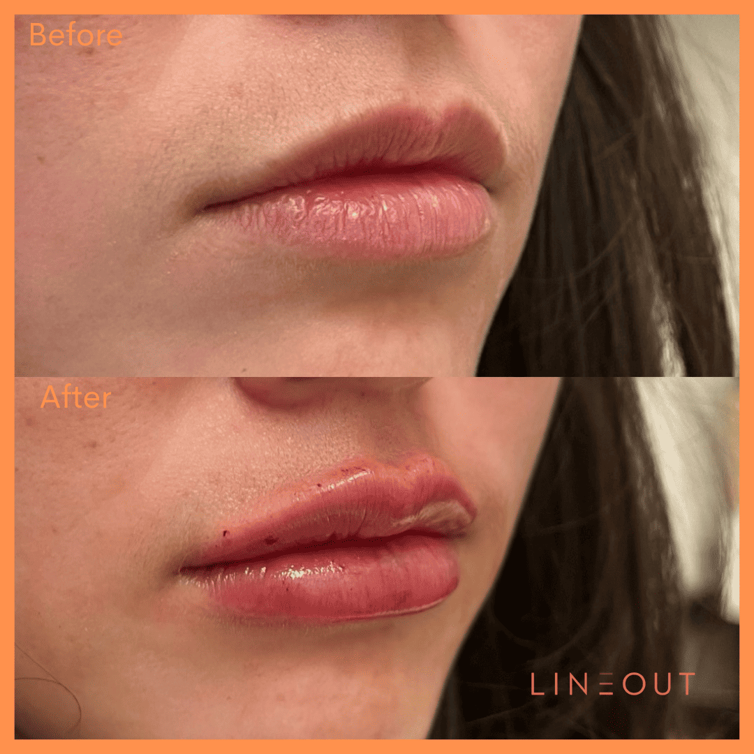 Before and After Lip treatment | LineOut Aesthetics | Carmel, IN