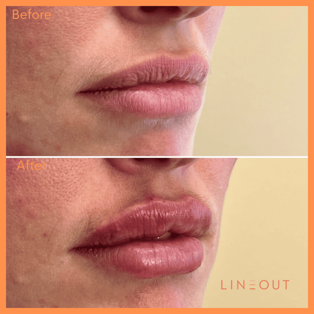 Before and After Lip treatment | LineOut Aesthetics | Carmel, IN